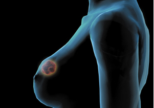哪些因素会增加女性乳腺癌病发机比例?