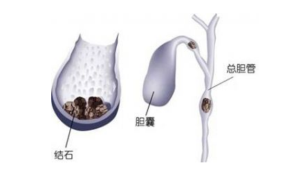 为什么要进行胆囊癌术后护理呢?