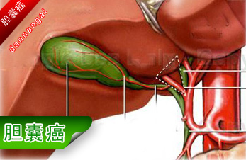 手术治疗给胆囊癌患者带哪些并发症?