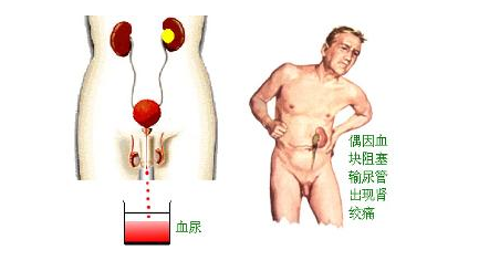 肾癌术后护理需注意事项