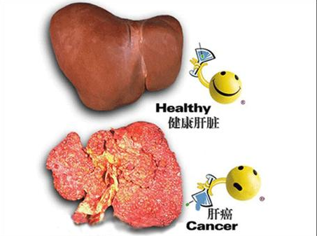 肝癌术后护理