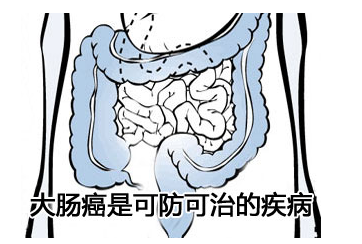 大肠癌晚期