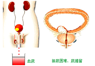膀胱癌预防