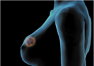 乳腺癌早期并发症