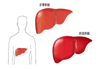 肝癌患者,饮食护理
