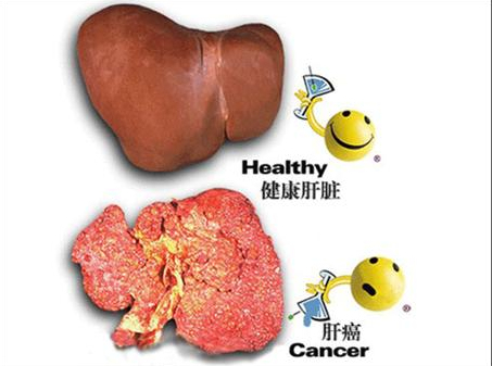 肝癌患者