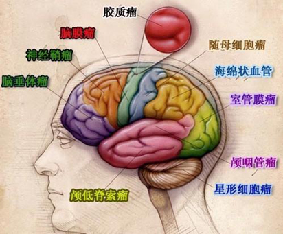 单眼突出,脑瘤早期并发症