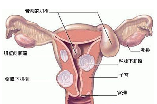 卵巢癌术后转移